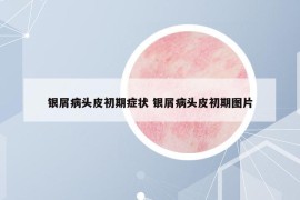 銀屑病頭皮初期癥狀 銀屑病頭皮初期圖片