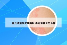 善元清適應(yīng)皮膚癬嗎 善元清乳膏怎么樣