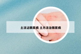 土法沾銀屑病 土方法治銀屑病