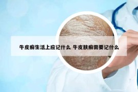 牛皮癬生活上應(yīng)記什么 牛皮膚癬需要記什么