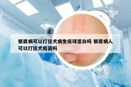 銀屑病可以打狂犬病免疫球蛋白嗎 銀屑病人可以打狂犬疫苗嗎