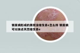 銀屑病形成的黑斑涂維生素e怎么樣 銀屑病可以抹點(diǎn)天然維生素e