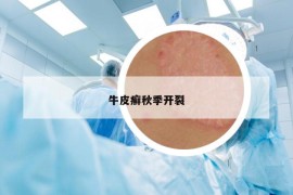 牛皮癬秋季開裂