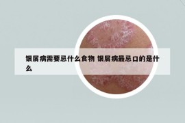 銀屑病需要忌什么食物 銀屑病最忌口的是什么