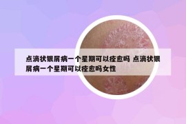 點(diǎn)滴狀銀屑病一個(gè)星期可以痊愈嗎 點(diǎn)滴狀銀屑病一個(gè)星期可以痊愈嗎女性
