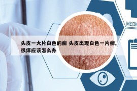 頭皮一大片白色的癬 頭皮出現(xiàn)白色一片癬,很癢應(yīng)該怎么辦