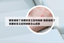 銀屑病用了青鵬軟膏之后特別癢 銀屑病用了青鵬軟膏之后特別癢怎么回事