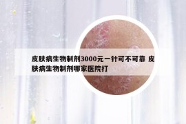 皮膚病生物制劑3000元一針可不可靠 皮膚病生物制劑哪家醫(yī)院打