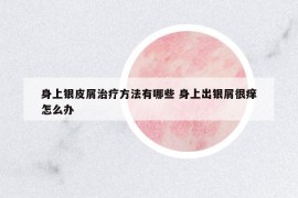 身上銀皮屑治療方法有哪些 身上出銀屑很癢怎么辦