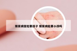 銀屑病冒險(xiǎn)要孩子 銀屑病能要小孩嗎