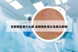 皮膚顏色是什么癬 皮膚顏色變化及提示疾病