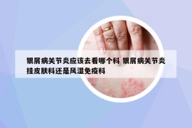 銀屑病關(guān)節(jié)炎應(yīng)該去看哪個(gè)科 銀屑病關(guān)節(jié)炎掛皮膚科還是風(fēng)濕免疫科