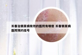 長春治銀屑病有效的醫(yī)院有哪些 長春銀屑病醫(yī)院預(yù)約掛號
