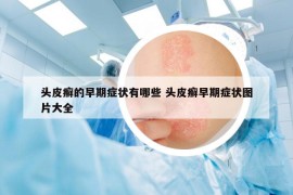 頭皮癬的早期癥狀有哪些 頭皮癬早期癥狀圖片大全