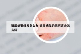 銀屑病要爆發(fā)怎么辦 銀屑病發(fā)的很厲害會怎么樣