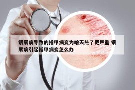 銀屑病導致的指甲病變?yōu)樯短鞜崃烁鼑乐?銀屑病引起指甲病變怎么辦