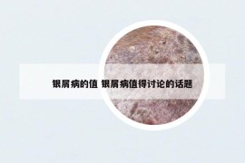 銀屑病的值 銀屑病值得討論的話(huà)題