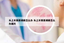 頭上長(zhǎng)銀屑病癬怎么辦 頭上長(zhǎng)銀屑病癬怎么辦圖片