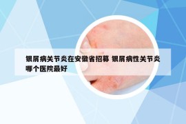 銀屑病關(guān)節(jié)炎在安徽省招募 銀屑病性關(guān)節(jié)炎哪個(gè)醫(yī)院最好