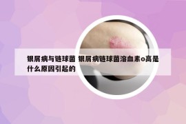 銀屑病與鏈球菌 銀屑病鏈球菌溶血素o高是什么原因引起的