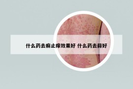 什么藥去癬止癢效果好 什么藥去蘚好