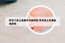 懷孕了身上有癬可以抹藥嗎 懷孕身上長癬能用藥嗎