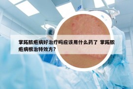 掌跖膿皰病好治療嗎應該用什么藥了 掌跖膿皰病根治特效方?