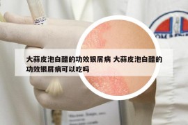 大蒜皮泡白醋的功效銀屑病 大蒜皮泡白醋的功效銀屑病可以吃嗎