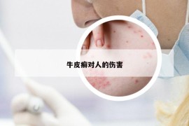 牛皮癬對人的傷害