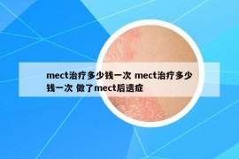 mect治療多少錢一次 mect治療多少錢一次 做了mect后遺癥