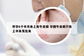 懷孕6個(gè)半月身上有牛皮癬 孕期牛皮癬只有上半身發(fā)出來(lái)
