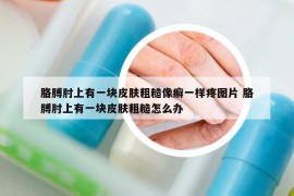 胳膊肘上有一塊皮膚粗糙像癬一樣疼圖片 胳膊肘上有一塊皮膚粗糙怎么辦