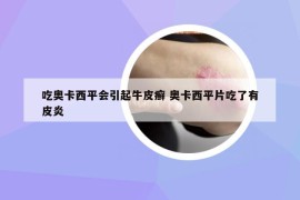 吃奧卡西平會引起牛皮癬 奧卡西平片吃了有皮炎