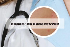 銀屑病能吃八角嘛 銀屑病可以吃八寶粥嗎