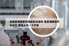 治銀屑病照紫外線前能洗澡嗎 銀屑病做紫外線光療,要做幾次一個(gè)療程