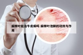 麻柳葉能治牛皮癬嗎 麻柳葉泡腳的功效與作用