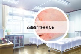 白癜瘋在鄭州怎么治