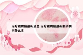 治療銀屑病最新消息 治療銀屑病最新的藥物叫什么名