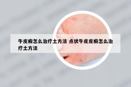 牛皮癬怎么治療土方法 點(diǎn)狀牛皮皮癬怎么治療土方法