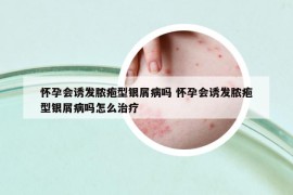 懷孕會誘發(fā)膿皰型銀屑病嗎 懷孕會誘發(fā)膿皰型銀屑病嗎怎么治療