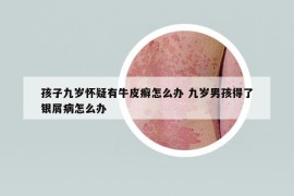 孩子九歲懷疑有牛皮癬怎么辦 九歲男孩得了銀屑病怎么辦