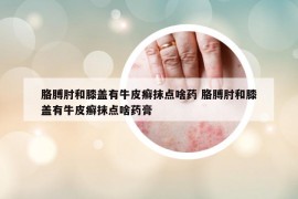 胳膊肘和膝蓋有牛皮癬抹點(diǎn)啥藥 胳膊肘和膝蓋有牛皮癬抹點(diǎn)啥藥膏