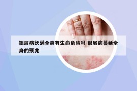 銀屑病長滿全身有生命危險嗎 銀屑病蔓延全身的預兆
