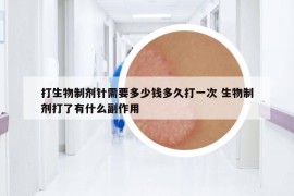 打生物制劑針需要多少錢(qián)多久打一次 生物制劑打了有什么副作用