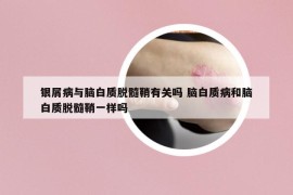 銀屑病與腦白質(zhì)脫髓鞘有關(guān)嗎 腦白質(zhì)病和腦白質(zhì)脫髓鞘一樣嗎