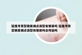 輕度尋常型銀屑病點(diǎn)滴型有銀屑嗎 輕度尋常型銀屑病點(diǎn)滴型有銀屑嗎會(huì)傳染嗎