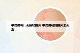 牛皮屑有什么癥狀圖片 牛皮屑初期圖片怎么治