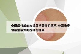 全國(guó)最權(quán)威的治銀屑病是哪家醫(yī)院 全國(guó)治療銀屑病最好的醫(yī)院在哪里