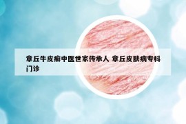 章丘牛皮癬中醫(yī)世家傳承人 章丘皮膚病?？崎T診
