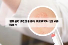 銀屑病可以吃玉米棒嗎 銀屑病可以吃玉米棒嗎圖片